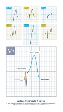 Farklı hastalıklar ve patofizyolojik koşullar altında, akut miyokardiyal iskeminin T dalgası küçük R dalgası ve büyük T dalgası ile karakterize edilen çeşitli formlara sahip olabilir..