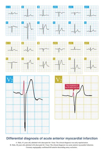 In case of acute anterior myocardial infarction and slight ST segment elevation in ECG, it is necessary to differentiate it from early repolarization. Follow up troponin and ECG.
