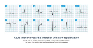 Erken repolarizasyon çoğunlukla iyi huylu bir ECG değişimidir ve ST segment yükselmesi bazen miyokardiyal enfarktüsle birlikte var olabilir..