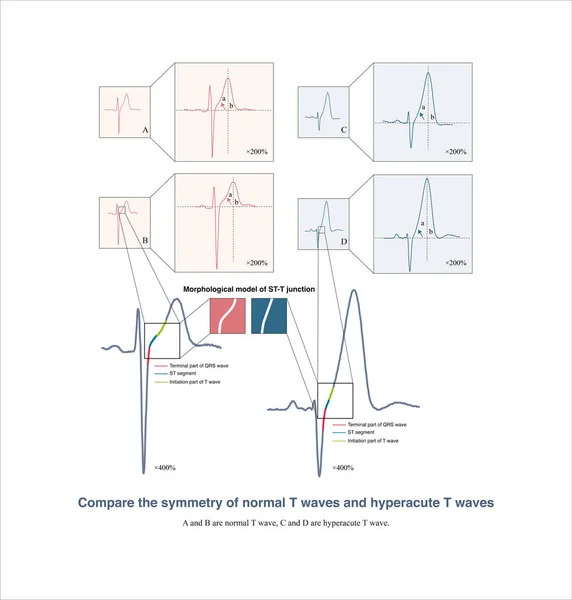 Ist Erwähnenswert Dass Viele Elektrokardiographische Lehrbücher Glauben Dass Hyperakute Wellen — Stockfoto