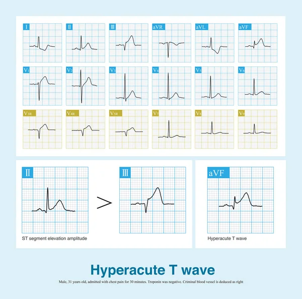 In the early stage of acute myocardial infarction, T wave is upright, with increased amplitude and symmetry, with or without ST segment elevation, which is called hyperacute T wave.