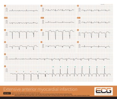 Geniş anterior ventrikül enfarktüsünün zanlı damarı sol anterior inen arterin en yaygın proksimal bölümüdür ve onu orta distal segment takip eder.. 