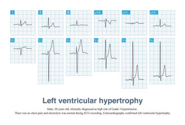 Sometimes, left ventricular hypertrophy with tall T waves is easily misdiagnosed as hyperkalemia and hyperacute T waves, and ECG needs to be carefully identified in combination with clinic. clipart