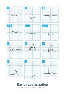 Erken repolarizasyonun ECG karakteristik değişimi J noktası ve ST segment yükselmesidir, ki bu da akut miyokardiyal enfarktüs olarak yanlış teşhis edilmesi kolaydır, özellikle hastanın semptomları varsa..