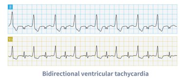 Bidirectional ventricular tachycardia is a kind of malignant arrhythmia. The polarity of QRS main wave alternates from beat to beat, and it is easy to degenerate into ventricular fibrillation. clipart