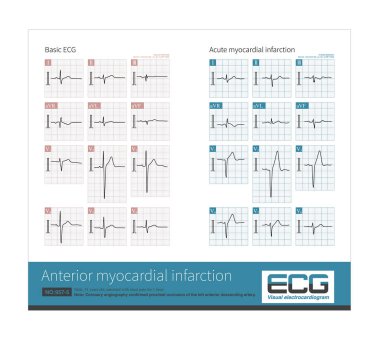 At present, there is a younger trend in patients with acute myocardial infarction, so it is important to check the ECG for acute chest pain in young people. clipart