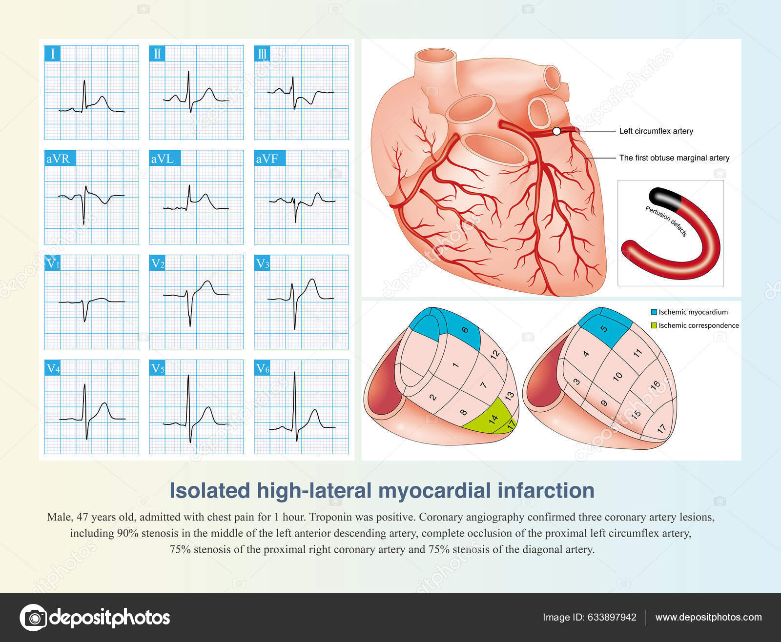 Isolated Occlusion Left Circumflex Artery Can Lead Isolated High