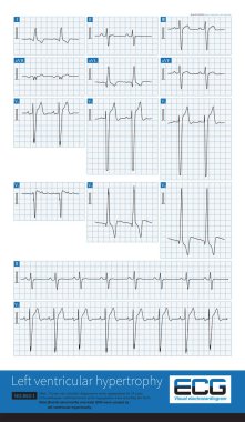 Aort kapakçığı regurjitasyonu oluştuğunda, diastole 'de, aorttan sol ventriküle kan geri dönüş hacmi sol ventriküler genişlemeye neden olur..