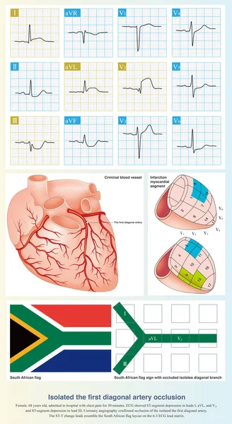 When the isolated first diagonal artery is occluded, ECG can show ST segment elevation in leads I, aVL, and V2, and ST segment depression in lead III, and the layout resembles the South African flag.