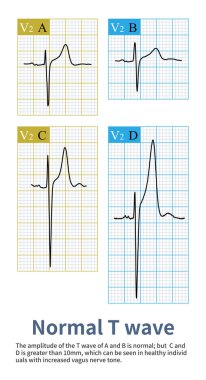 The upper limit of normal T wave amplitude generally does not exceed 10 mm, but sometimes normal people also have high amplitude T waves, which are common in athletes, bradycardia, and high vagus tone.