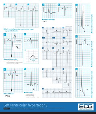 Left ventricular hypertrophy can cause a series of ECG changes such as left axis deviation, atrial abnormality, prolongation of QRS duration and ST-T change.