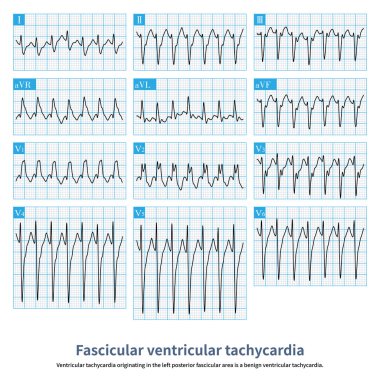 Ventricular tachycardia originating in the left posterior fascicular area is a benign ventricular tachycardia.QRS wave is similar to complete RBBB with left anterior fascicular block.