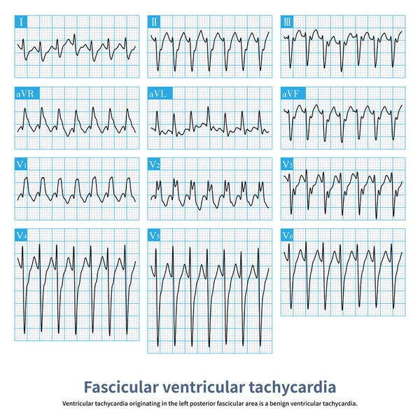Ventricular tachycardia originating in the left posterior fascicular area is a benign ventricular tachycardia.QRS wave is similar to complete RBBB with left anterior fascicular block.