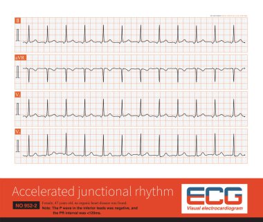 The retrograde P wave of the inferior leads can come from the lower part of the atrium, the lower part of the atrial septum, and the atrioventricular junctional region. 