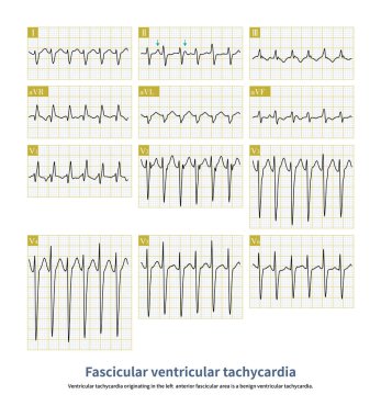 Idiopathic ventricular tachycardia, if originating from the left anterior fascicular region, it is similar to the right bundle branch block pattern with right axis deviation.