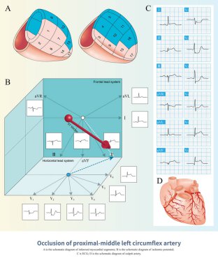 When the proximal and middle segments of the LCA  were occluded, the ischemic potential was toward the rear, left and lower, and the corresponding ECG leads showed ST segment elevation.