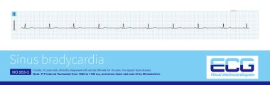 When the frequency of sinus impulses is less than 60 times per minute, it is called sinus bradycardia. Sinus bradycardia is a common bradyarrhythmia.