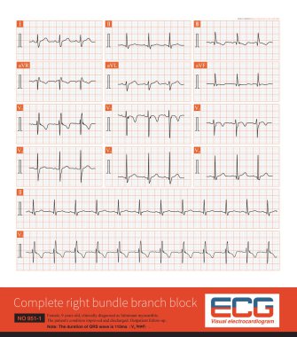 2009 yılında, Amerikan AHA ECG kılavuz ilkeleri 4 ila 16 yaşındaki çocukları tanımlamıştır ve QRS süresi 110 metre olarak tanımlanabilir..