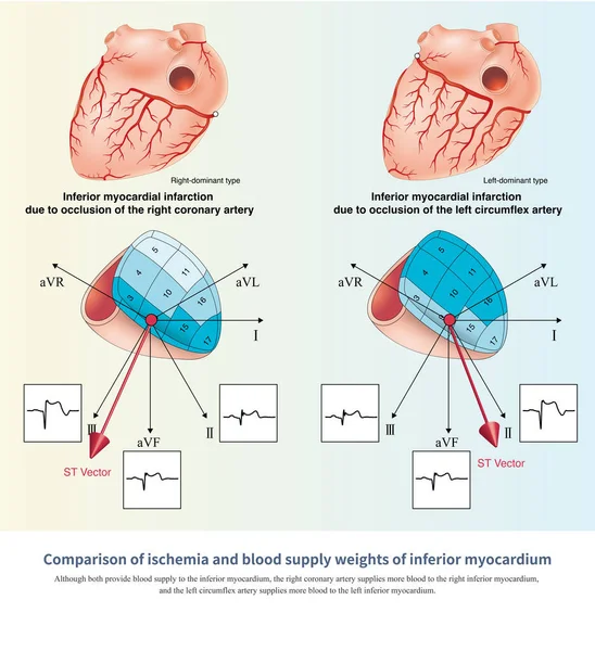 When acute inferior myocardial infarction occurs, the amplitude of ST segment elevation of ECG leads II and III can be used to interpret the culprit artery.