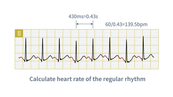 In daily work, the horizontal 1 mm represents 40 ms of time in the small square of ECG. Therefore, the frequency of cardiac rhythm can be calculated by using the horizontal small square.