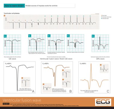 Ventricular fusion wave is a QRS wave generated by impulses from different sources in the ventricle that jointly excite the ventricle.QRS complex of ventricular fusion wave is variable.