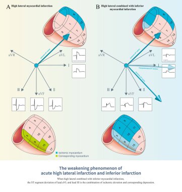 When two opposite myocardium are ischemic at the same time, the ST segment deviation depends on the combination of ischemic elevation and corresponding depression.