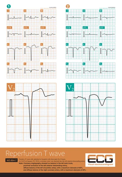 In acute ST-segment elevation myocardial infarction, the T wave is upright at the initial stage of the onset, and once the T wave begins to invert, it indicates the beginning of reperfusion.