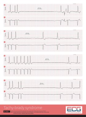 After the paroxysmal atrial fibrillation attack stopped, there was a long period of sinus arrest and sinus bradycardia. This phenomenon suggests sick sinus syndrome.