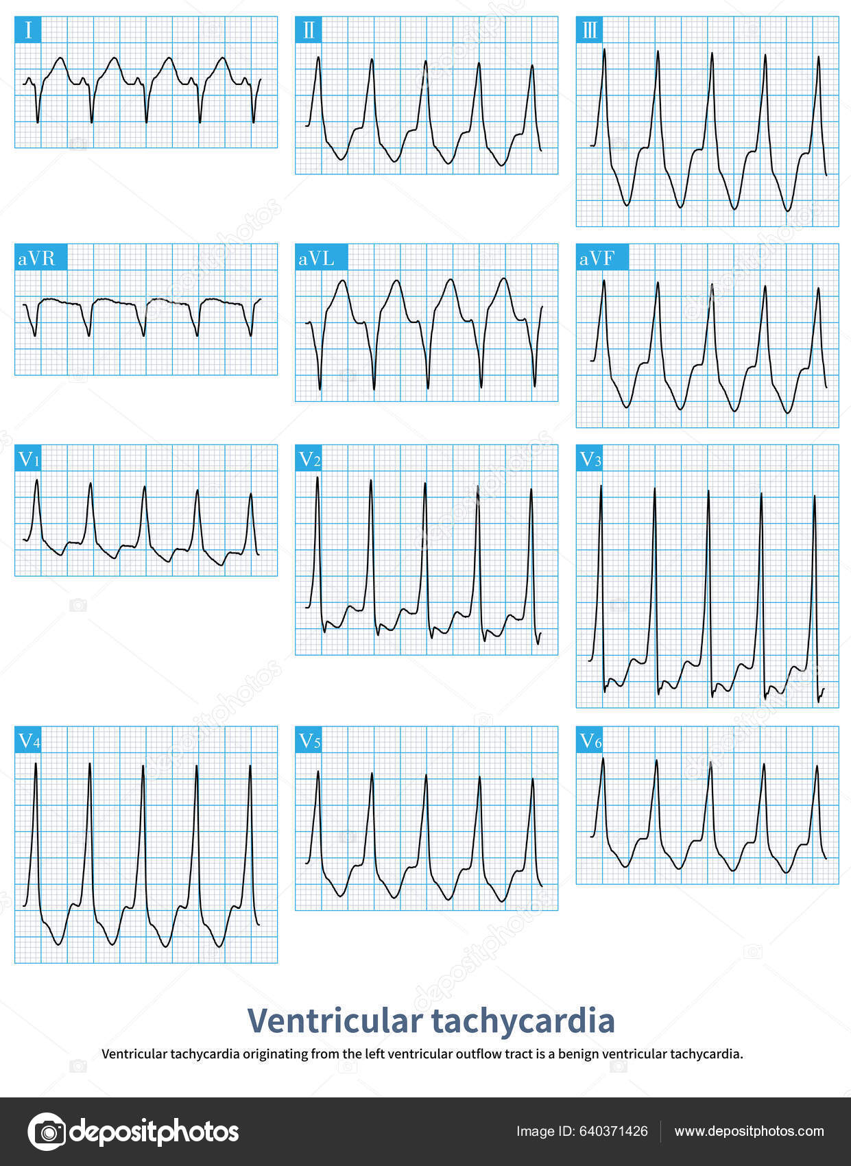 Ventricular Tachycardia Originating Left Ventricular Outflow Tract ...