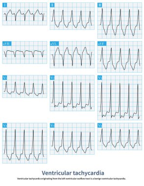 Ventricular tachycardia originating from the left ventricular outflow tract is a benign ventricular tachycardia.It usually does not cause sudden death.Radiofrequency ablation can cure this arrhythmia.