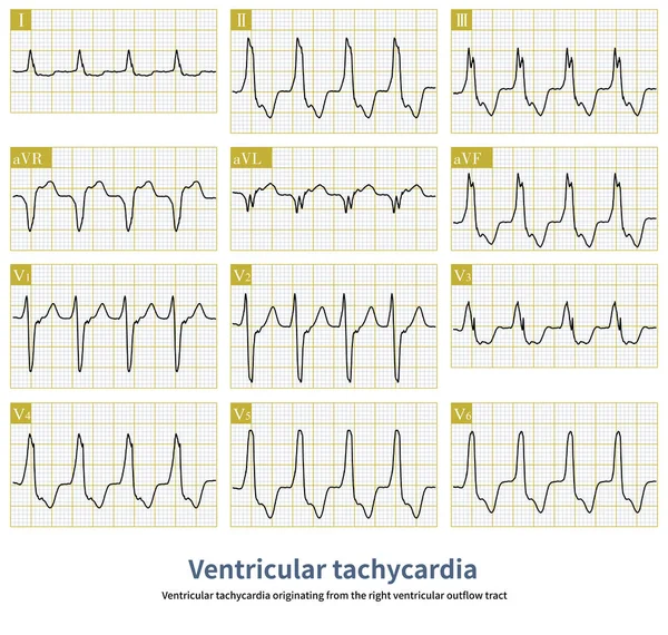 Ventricular Tachycardia Originating Right Ventricular Outflow Tract Benign Ventricular Tachycardia — Stock Photo, Image