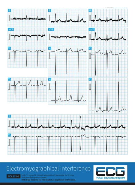 Baseline Ecg Interfered Its Own External Electrical Signal Affect Shape — Stock Photo, Image