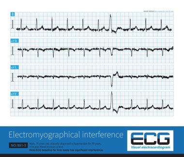When the baseline of ECG is interfered by its own or external electrical signal, it will affect the shape and measured value of ECG wave, especially ST segment offset amplitude.