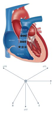 The figure shows the nine zones of the right ventricular outflow tract and the frontal hexaxial reference system. For VT from different regions, the QRS wave shape is some different.
