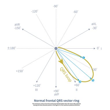 When ventricular depolarization occurs, the maximum QRS potential of the comprehensive depolarization potential on the frontal plane determines the orientation of the QRS axis.