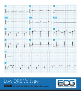 The QRS wave amplitude of each limb lead is less than 5mm, which is called limb lead low voltage. It can be seen in some physiological phenomena as well as organic heart disease.