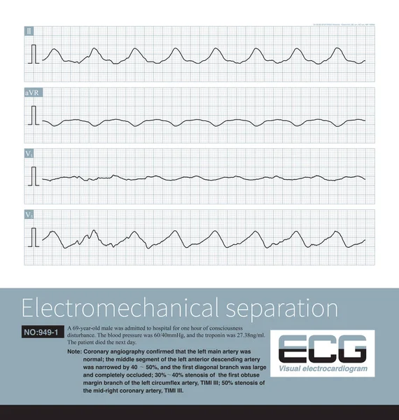 Electromechanical Separation Kind Terminal Ecg Patient Ecg Has Electrical Signals — Stock Photo, Image