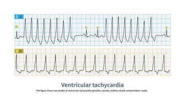 A is an endless pattern of ventricular tachycardia, and the yellow circle shows sinus heartbeat. B is a persistent pattern of ventricular tachycardia.