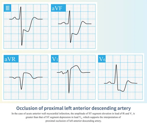 In the case of acute anterior myocardial infarction, the amplitude of ST segment offset can be used to deduce that the occlusive site is located in the proximal segment of the LAD.