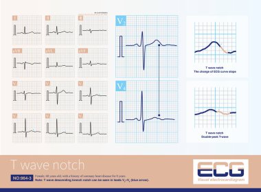 When the repolarization desynchronization difference between the left and right ventricles increases, T-wave notches appear on ECG, including physiologic and pathological causes.