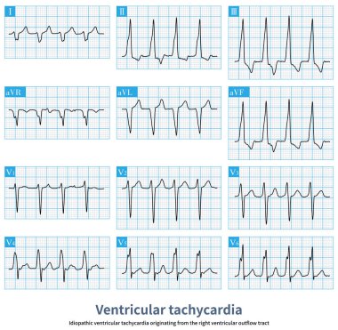 The patient's ventricular tachycardia has nothing to do with organic heart disease, and the arrhythmia originates from the right ventricular outflow tract.
