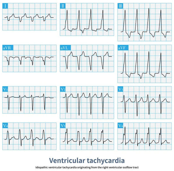 Patient Ventricular Tachycardia Has Nothing Organic Heart Disease Arrhythmia Originates — Stock Fotó