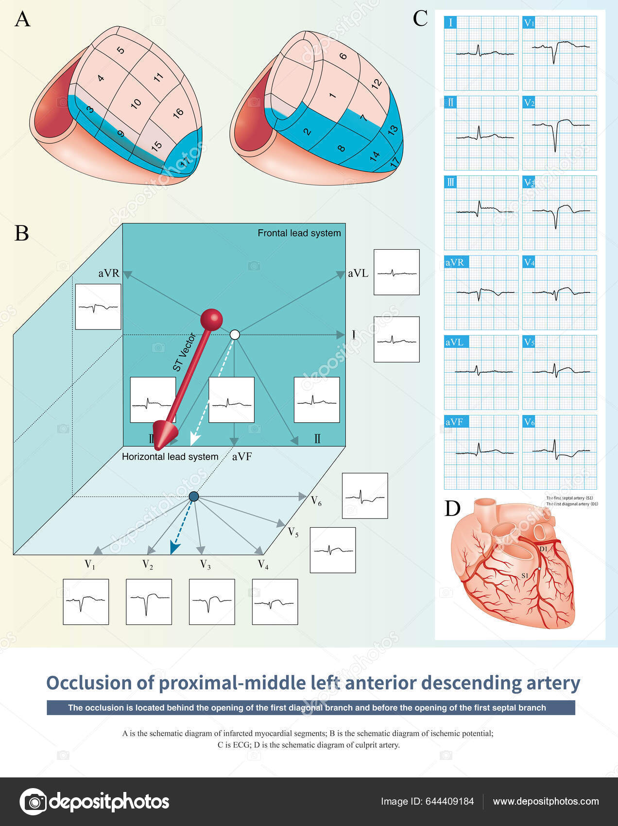 Occlusion Lad Affects First Septal Branch First Diagonal Branch