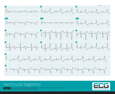 14 yaşındaki lösemili bir çocuğun ani QRS taşikardisi vardı ve 167 bpm frekansı vardı ve ritim düzenliydi. Anti-aritmi tedavisinden sonra hasta ventriküler bigeminiye girdi..