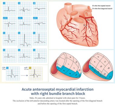 Akut anteroseptal miyokardiyal enfarktüs sağ demet bloğuyla birleştiğinde, V1 'deki QRS dalgası tipik bir QR dalgası gösterir, ve ilk r dalgası kaybolur..