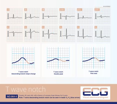 Aynı hastada T dalgası çentiği, T dalgası alçalan çentikler, çift tepeli ve düz-tepe T dalgası olarak ortaya çıkabilir..