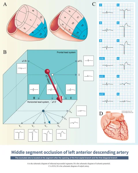 Stock image When the middle - distal segments of the LAD were occluded, the ischemic potential was toward the anterior, inferior and left, and the infarct spread to the anterior lower part of the left ventricle.