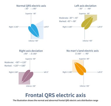 Ön QRS elektrik ekseni genel ventriküler depolarizasyonun ortalama potansiyelidir ve baskın sol ventriküler kütle nedeniyle, normalde sol ve alt yönlüdür.