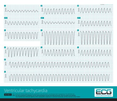 14 yaşındaki lösemili bir çocuğun ani QRS taşikardisi vardı ve 167 bpm frekansı vardı ve ritim düzenliydi. Anti-aritmi tedavisinden sonra hasta sinüs ritmine kavuştu..