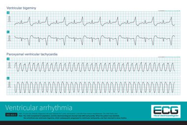 14 yaşındaki lösemili bir çocuğun ani QRS taşikardisi vardı ve 167 bpm frekansı vardı ve ritim düzenliydi. Anti-aritmi tedavisinden sonra hasta sinüs ritmine kavuştu..